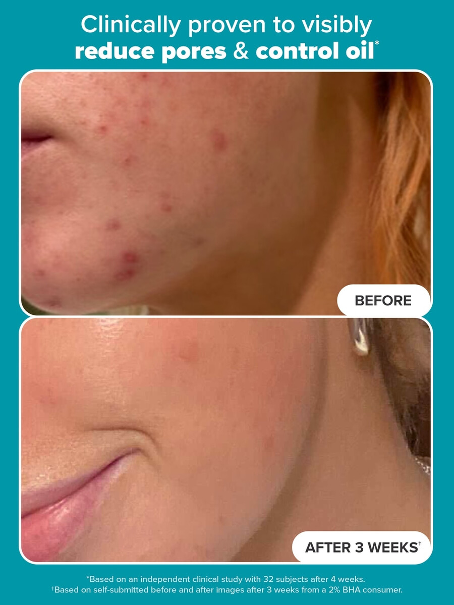 tekutý exfoliant pro zdokonalení pleti s 2 bha